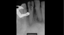 Calcified Incisor - How To Read A Near Miss Radiograph