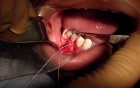 Part 5/8: Root Coverage Surgery - Mandibular Premolar - Keep That In Place