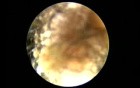 Synechia In External Ear Canal Post Mastoidectomy