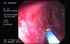 Radiation Proctosigmoiditis (5 of 14)