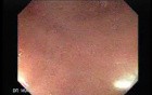 Gastrointestinal Stromal Tumour of the Rectum (3 of 3)