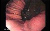 Hiatus Hernia (1 of 3)