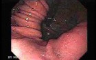 Hiatus Hernia (1 of 3)
