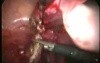 Endométriome Inclus Dans Mesosigmoïde