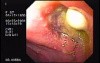 Partial Dehiscence of Suturing with Gastro-cutaneous Fistula (4 of 4)