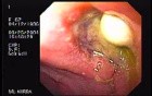 Partial Dehiscence of Suturing with Gastro-cutaneous Fistula (4 of 4)
