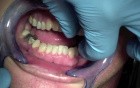 Mandible Fracture - Movement