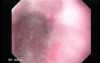 Barrett's Esophagus of long segment -GERD (3 of 11)