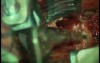 Cervical Solitary Plasmocytoma - Vertebrectomy And Arthrodesis Anterior Route