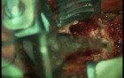Cervical Solitary Plasmocytoma - Vertebrectomy And Arthrodesis Anterior Route