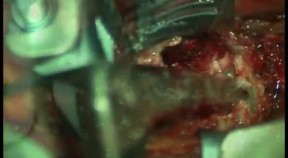 Cervical Solitary Plasmocytoma - Vertebrectomy And Arthrodesis Anterior Route