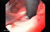 Scirrhous Gastric Carcinoma - Endoscopy (4 of 47)