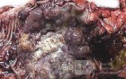 Colon Adenocarcinoma, Villous Adenocarcinoma (6 of 12)