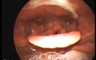 Tracking The Mucopus Trails Towards Its Source in Sinusitis