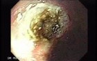 Multiple Gastric Angiodysplasia (13 of 17)