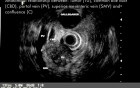 EUS radial scanning of pancreatic cacrinoma