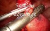 Laparoscopic Management Of Meckel's Diverticulum