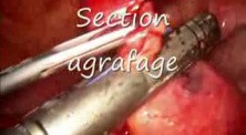 Laparoscopic Management Of Meckel's Diverticulum