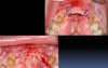 Mandibular Anterior Teeth Replacement With Implant Bridge