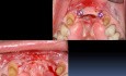 Mandibular Anterior Teeth Replacement With Implant Bridge