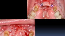 Mandibular Anterior Teeth Replacement With Implant Bridge