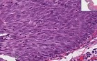 Squamous metaplasia And carcinoma - Histopathology - Cervix