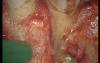 Complicated Tooth Root Fracture