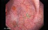 Non Familial Juvenile Polyposis Of The Colon (16 of 37)