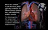 Deep Vein Thrombosis and Subsequent Pulmonary Embolism
