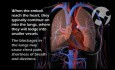 Deep Vein Thrombosis and Subsequent Pulmonary Embolism