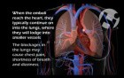 Deep Vein Thrombosis and Subsequent Pulmonary Embolism