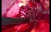 Transgastric Stent Removal - Laparoscopy