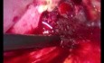 Transgastric Stent Removal - Laparoscopy
