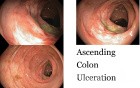 Ascending Colon Ulceration