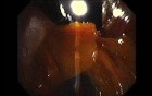 Gastrointestinal Stromal Tumor - GIST (39 of 65)