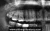 3Rd Molar Extractions - Maxillary Molar Apices