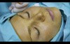 Scarless Cheek bone lift
