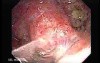 Severe case of Ischemic Colitis (9 of 19)