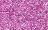 Renal cell carcinoma (hypernephroma) - Histopathology - Kidney