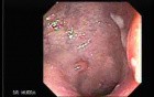 Cap Polyposis