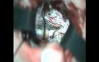 Aneurysm Clipped