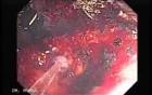 Endoscopic Resection of Giant Tubulo-Villous of the rectum (35 of 35)