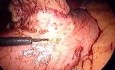 Laparoscopic wide excision of GIST