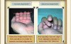 Common Hand Injuries: Part-2