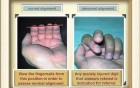 Common Hand Injuries: Part-2