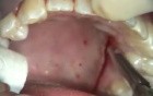 Connective Tissue Grafting