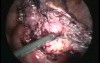 Removal of Heterotrophic Abdominal Pregnancy by Laparoscopic Technique
