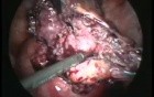 Removal of Heterotrophic Abdominal Pregnancy by Laparoscopic Technique