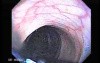 Juvenile Non Familial Polyposis of the Colon (30 of 37)