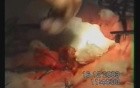 Colon Cancer Surgery 